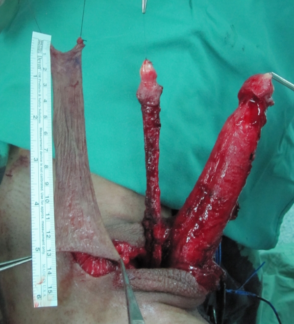Penis Inversion Surgery 17