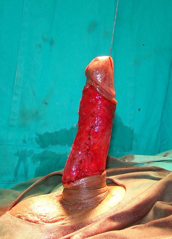 Correcting A Curved Penis 11