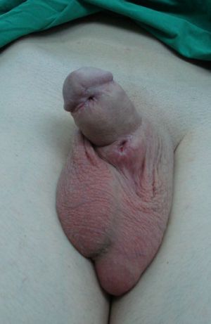 Baby Born With Penis And Vagina 55