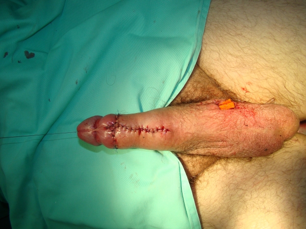 Penis Augmentation Surgery 13