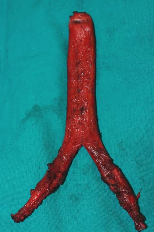 Penis Inversion Surgery 73